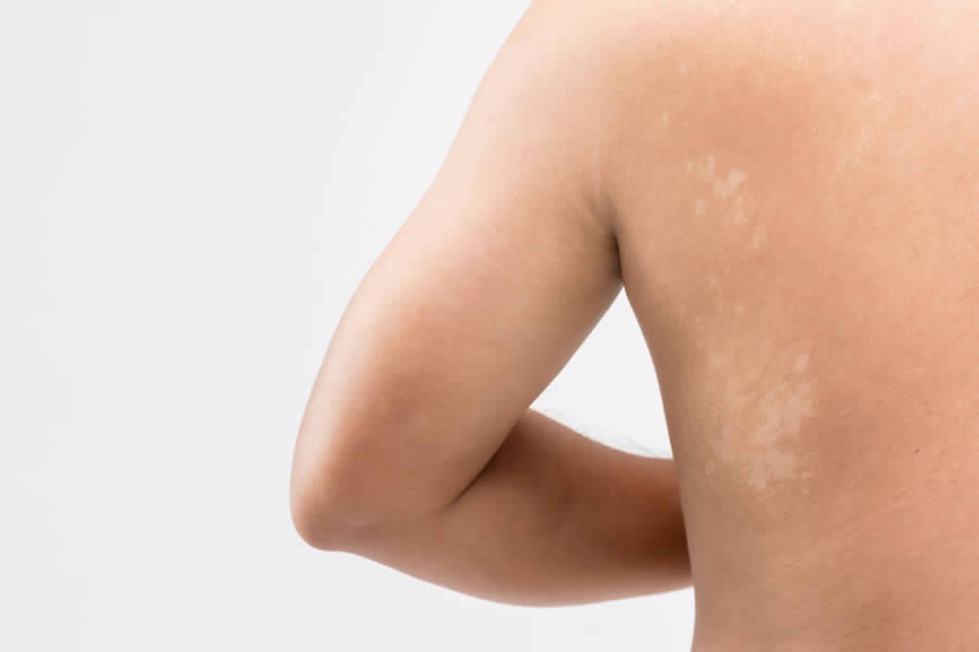 Homem com micose de praia pano branco nas costas